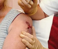 e-raze, non-laser tattoo removal